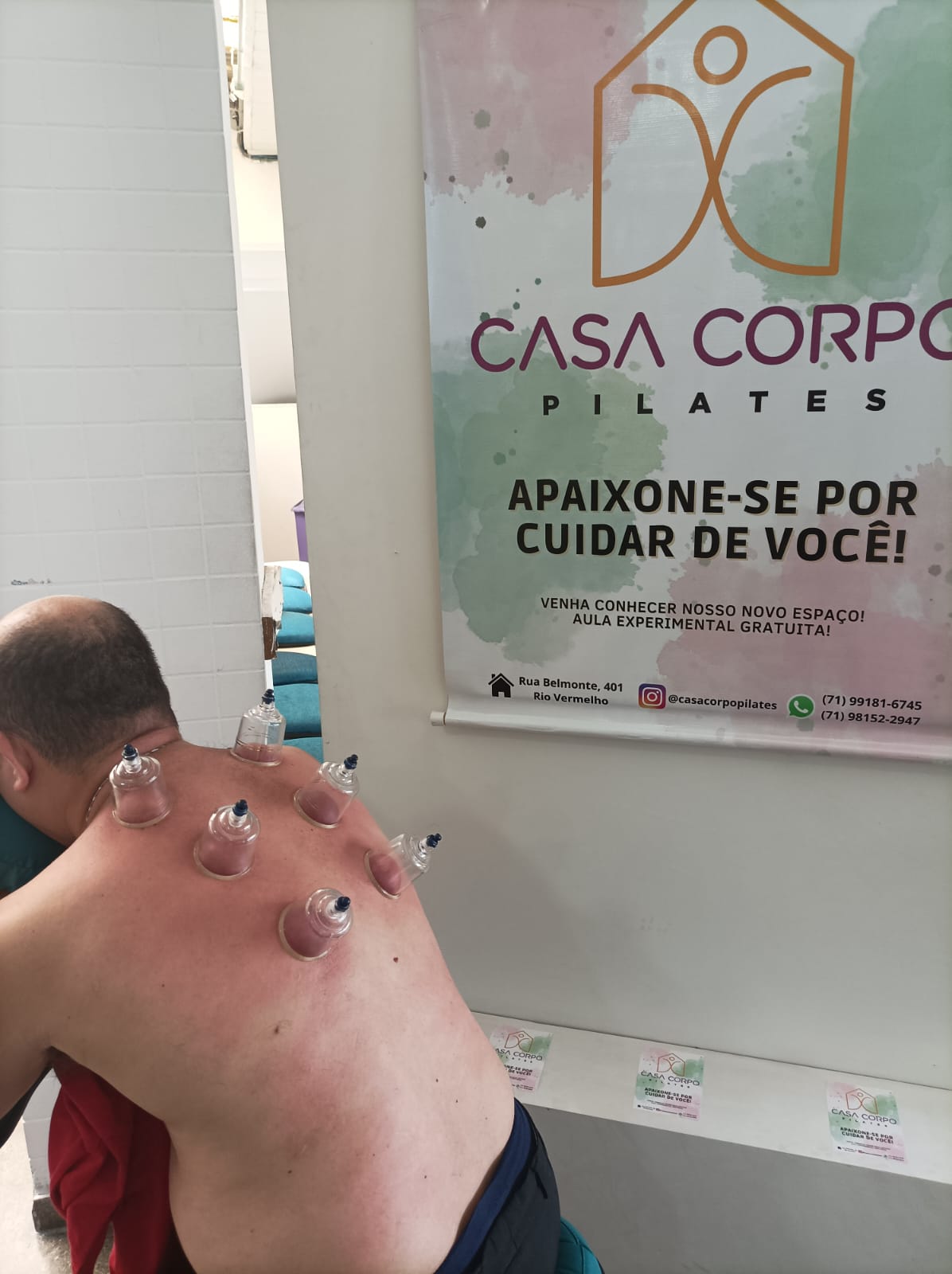 Liberação Miofascial e Ventosaterapia